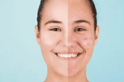 cbd et acné
