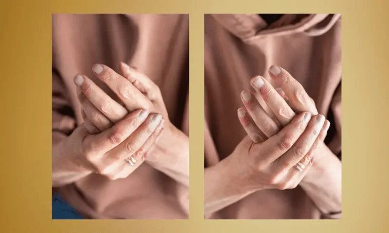 cbd eczéma sur les mains